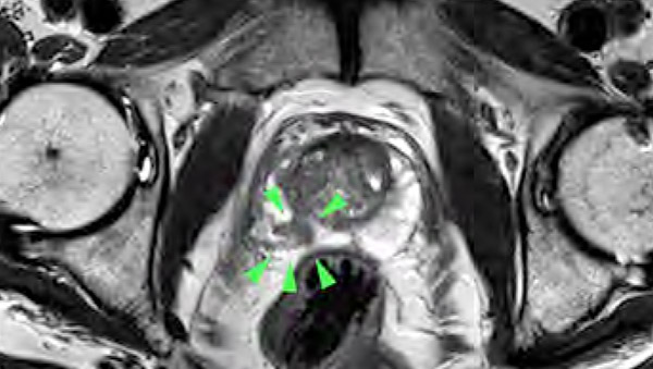 radiologie-darmstadt-neue-untersuchungsmethode-prostatakrebs
